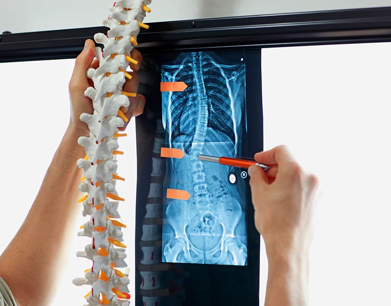 scoliosis chiropractor in San Diego, CA
